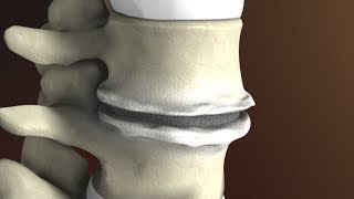 Degenerative Disc Disease Spondylosis explained by Spine Surgeon Dr Jessica Shellock Plano TX [upl. by Rogergcam]