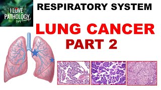 Diagnosing Lung Adenocarcinoma Biopsying Adequate Tissue [upl. by Ayila]