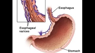 Esophageal Varices [upl. by Noral]