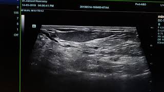 Fibrocystic Breast Disease Sonography [upl. by Dorrahs]