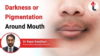 Darkness or Pigmentation Around Mouth  Darkening Around Mouth Causes  Treatment  Dermatologist [upl. by Tannenwald]