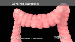 Irritable Bowel Syndrome IBS [upl. by Gaughan]