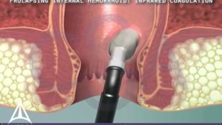 Infrared Coagulation Therapy for Hemorrhoids  3D Medical Animation [upl. by Sidonie]