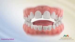 Orthodontic Treatment for Tongue Thrusting Habit  Different Options [upl. by Lilah]