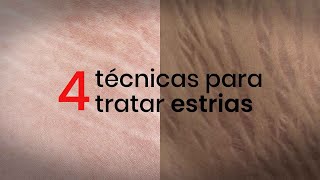 4 técnicas para tratar estrias [upl. by Cassondra]