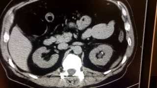 CT scan of kidney disease [upl. by Aiela696]