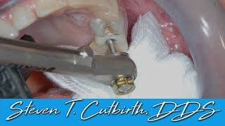 Loose Implant Screw  Dental Minute with Steven T Cutbirth DDS [upl. by Macintosh]