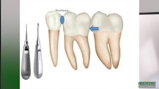 How to make molar extractions easier [upl. by Killarney346]