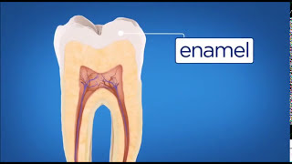 Five stages of Tooth decay [upl. by Erin]