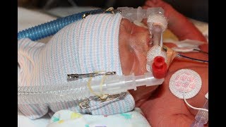 NICU Procedures Bubble CPAP [upl. by Rudiger]