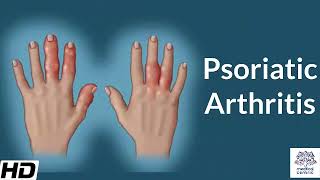 Psoriatic Arthritis  Everything You Need To Know  Dr Nabil Ebraheim [upl. by Enneiviv]