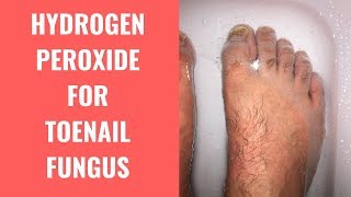 Hydrogen Peroxide Effective For Treating Toenail Fungus [upl. by Leiso345]