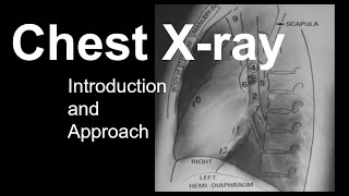 Chest Xray Introduction and Approach [upl. by Maximilianus]