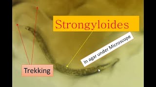 Strongyloidiasis cause and its pathogenesis Strongyloides under microscope [upl. by Esdnyl]