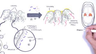 Tonsillectomy for Children  You Oughta Know 2021 [upl. by Hilda724]