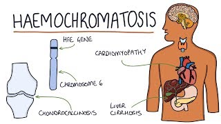 Understanding Haemochromatosis [upl. by Nickolai]