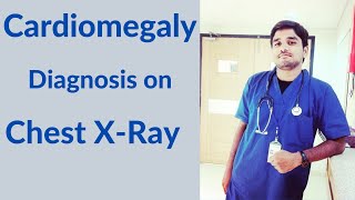 Cardiomegaly diagnosis on XRays [upl. by Ittam882]