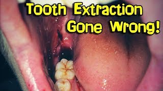 Wisdom Teeth Removal Extraction [upl. by Hsirrehc]