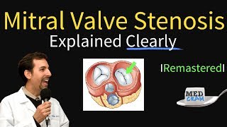 Mitral Valve Stenosis Diagnosis Treatment Pathophysiology [upl. by Ahcire883]