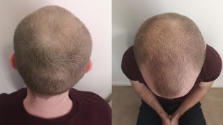 Pumpkin Seed Oil for Hair Loss 24 Week Experiment [upl. by Wollis741]