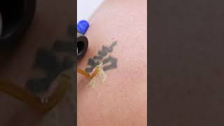 Laser Tattoo Removal Process [upl. by Warring]