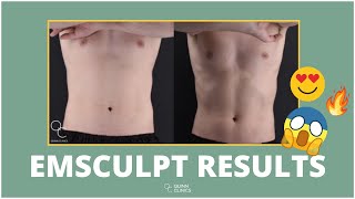 EMSCULPT  Before amp After’s   Is it WORTH it  amp Does it WORK  Quinn Clinics Bristol [upl. by Navoj]