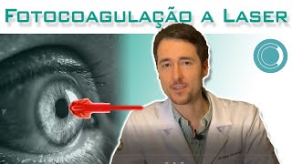 Fotocoagulação a laser para doenças da retina [upl. by Osana378]