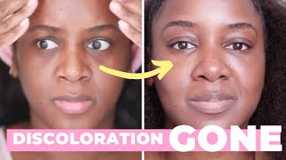 How I Got Rid of My Dark Circles Black Skin [upl. by Yelak990]