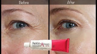 5Year RetinA Update  Before amp After for Wrinkles amp AntiAging [upl. by Iggep254]