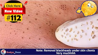 Removal Blackheads under skin clients Very Much  Acne Treatment 112 [upl. by Oznecniv]