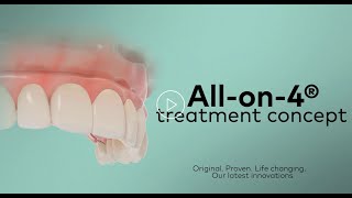 ALLON4 Nobel Biocare Implants Explained [upl. by Sinnek]