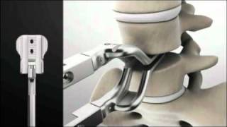 Spinal Kinetics M6L Artificial Disc Replacement Surgery Animation [upl. by Root]