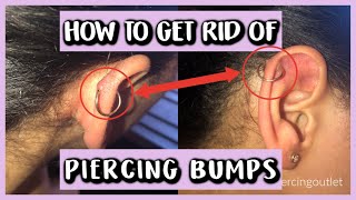 HOW TO GET RID OF PIERCING BUMPS [upl. by Allianora445]