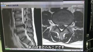 腰椎椎間板ヘルニア手術（PELD）症例解説【岩井整形外科内科病院】 [upl. by Pazit]