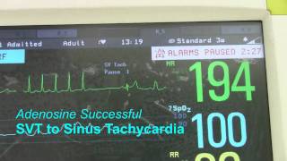 SVT or Supraventricular Tachycardia [upl. by Akeber]