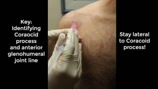 Glenohumeral Shoulder Injection [upl. by Triplett]