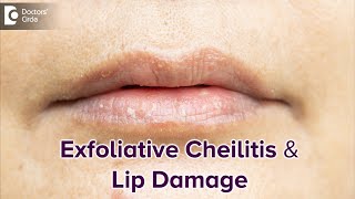 Exfoliative Cheilitis amp its effect on Lips  DRY LIPSBest TreatmentDrRasya Dixit Doctors Circle [upl. by Sonia]