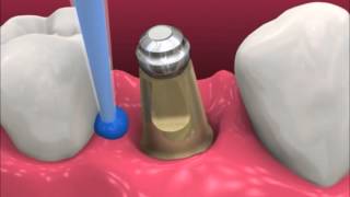 Smyl Manatee  Dental Implant Procedure [upl. by Assilen]