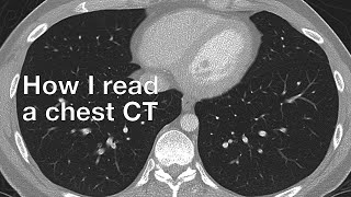 How I Read a Chest CT [upl. by Zinnes]