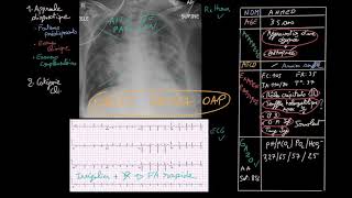 Insuffisance cardiaque aiguë en 3 étapes  Partie 1  Docteur Synapse [upl. by Risteau]