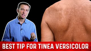 Natural Skin Fungus Tinea Versicolor Home Remedies – Dr Berg [upl. by Elysia]