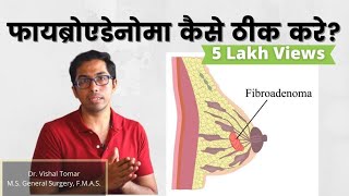 Breast Fibroadenoma explained in Hindi  Dr Vishal Tomar  Open Consult [upl. by Annauqal]