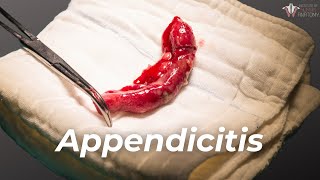 What Causes Appendicitis amp How to Treat It [upl. by Mohorva355]