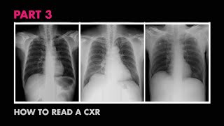 How XRays Work  How to Read a Chest XRay Part 3  MEDZCOOL [upl. by Cristabel]