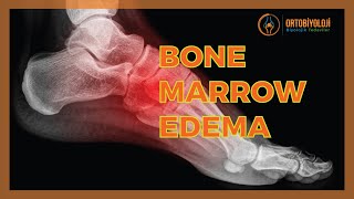 BONE MARROW EDEMA TREATMENTS [upl. by Yemiaj168]