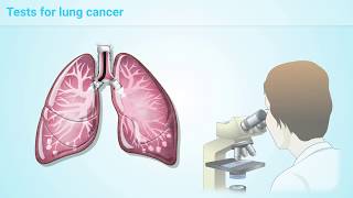 Understanding NonSmall Cell Lung Cancer [upl. by Norga]