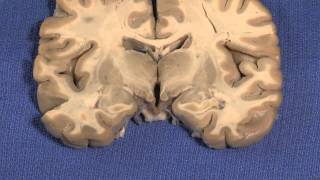 Hypothalamus Neuroanatomy Video Lab  Brain Dissections [upl. by Ylecic161]