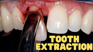 Tooth Extraction Explained  Wisdom Teeth Extraction Aftercare [upl. by Ethelstan132]