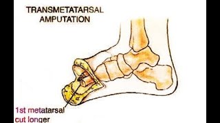 Transmetatarsal Amputation [upl. by Atilamrac866]