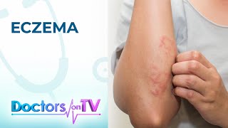 Eczema Symptoms Causes and Treatment  Doctors on TV [upl. by Stetson]